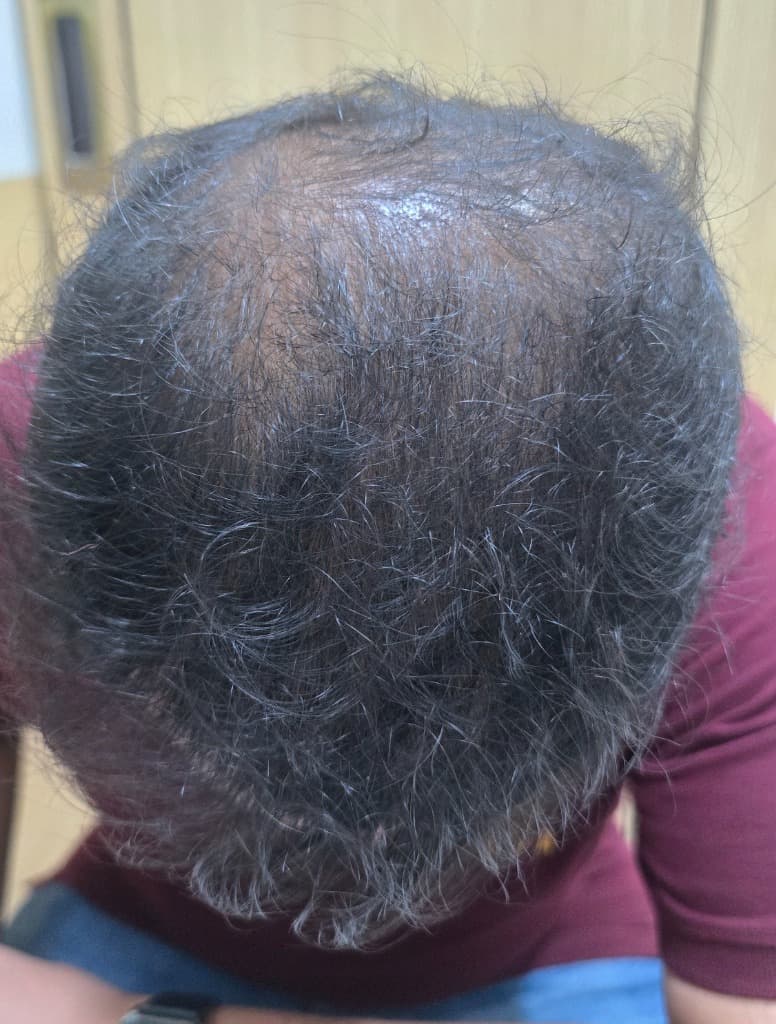 After - Androgenetic Alopecia Case Study