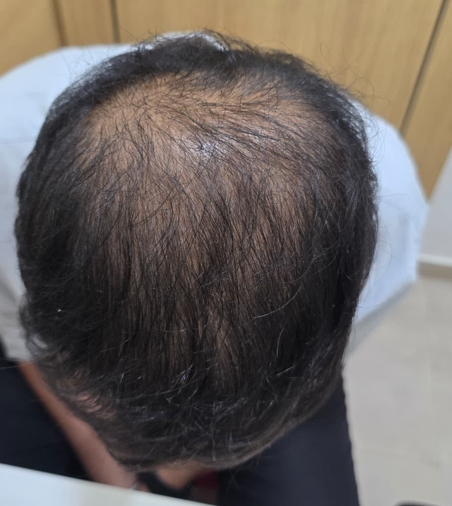 Before - Androgenetic Alopecia Case Study