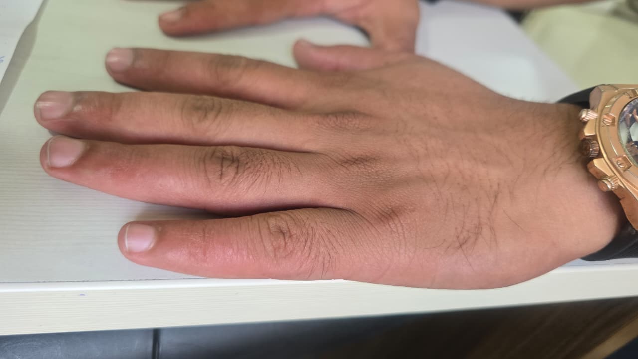 After - Hyperhidrosis Treatment Case Study