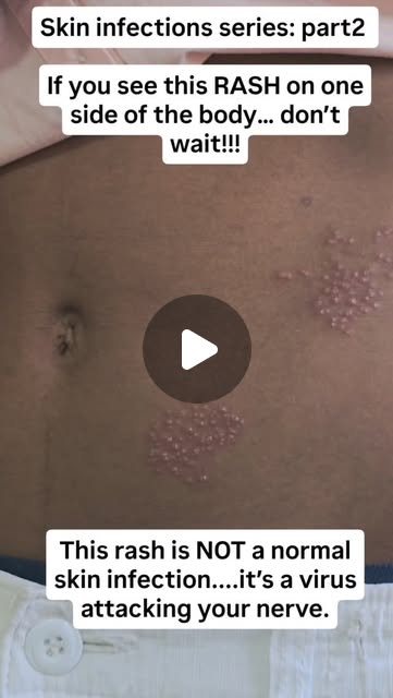 Herpes Zoster (Shingles): Nerve Pattern Rash & Reactivation